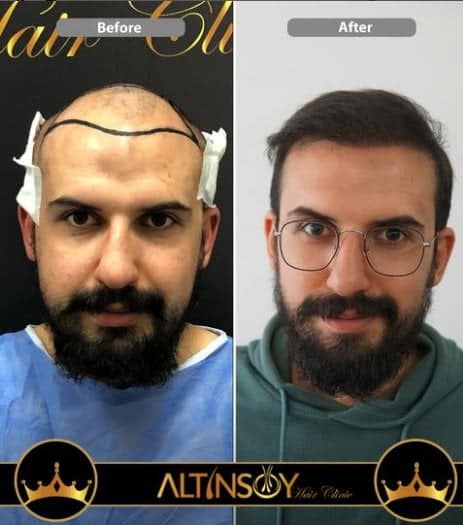 Altınsoy Hair Clinic