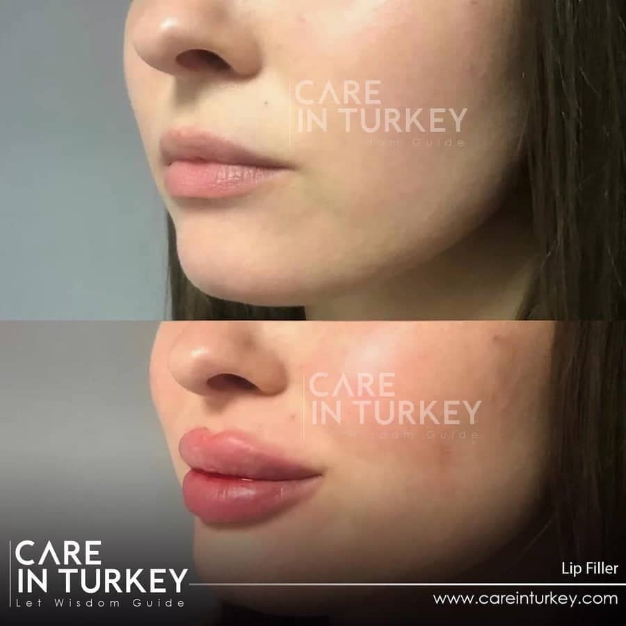 Care in Turkey