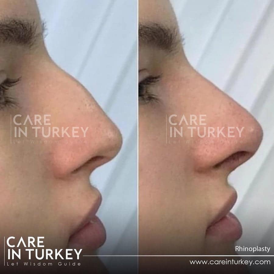 Care in Turkey
