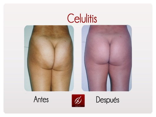 Clínica Láser Puebla