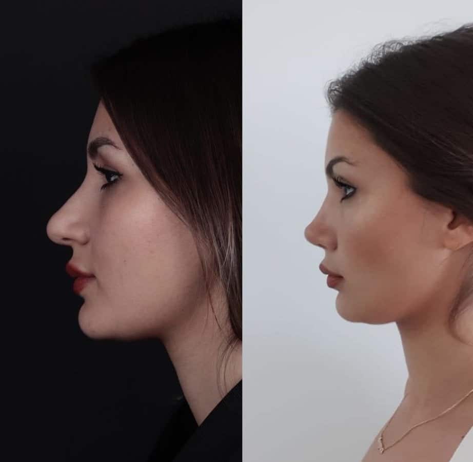 Harun Acipayam Rhinoplasty Clinic