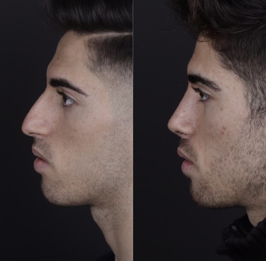 Harun Acipayam Rhinoplasty Clinic