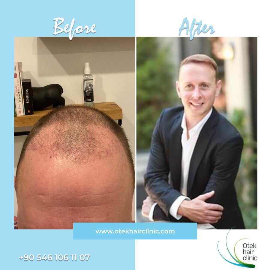 OTEK Hair Clinic