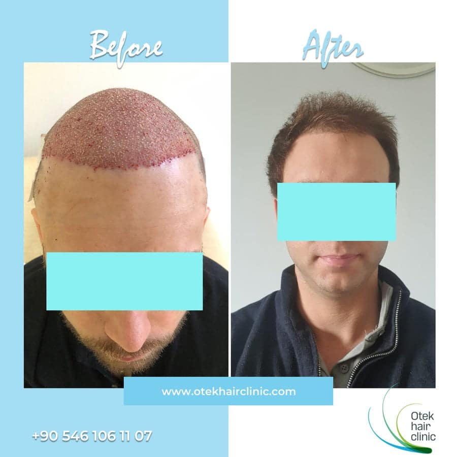 OTEK Hair Clinic