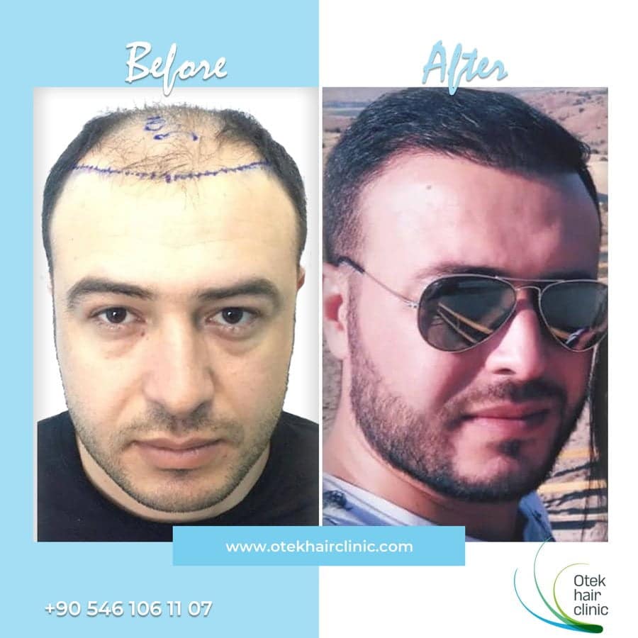 OTEK Hair Clinic