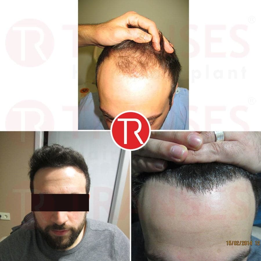 Transes Hair Transplant