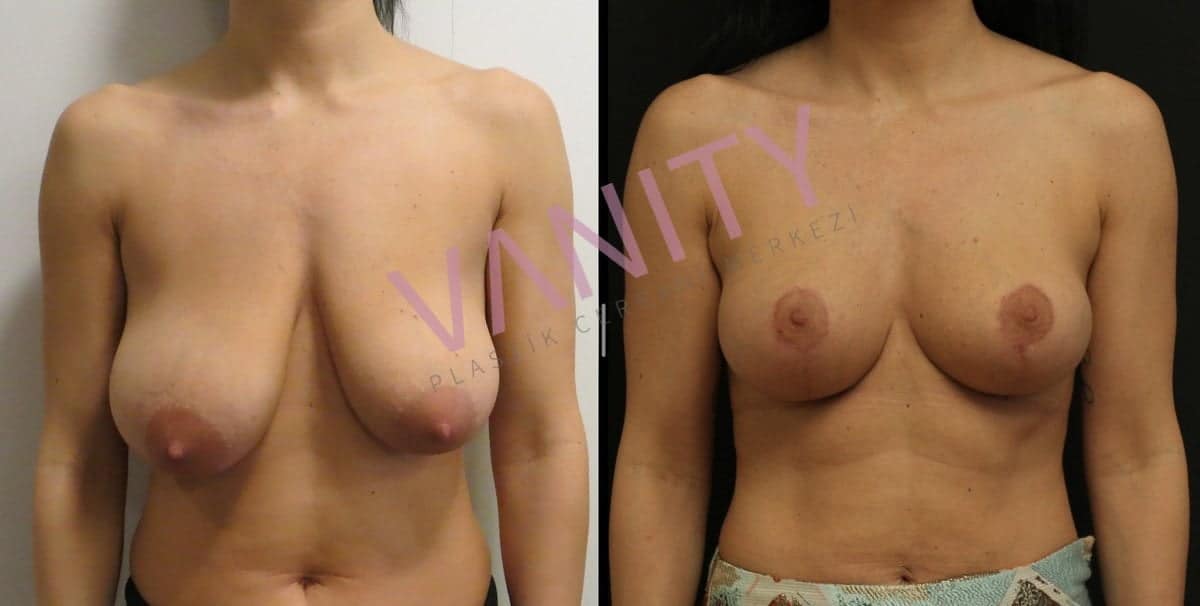 Vanity Cosmetic Surgery Hospital İstanbul