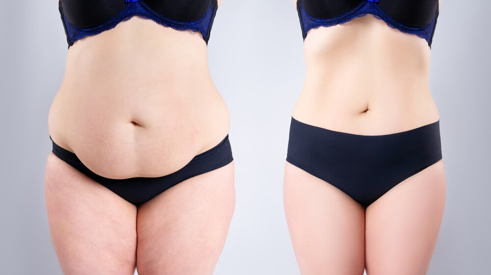 Plastic Surgery After Weight Loss